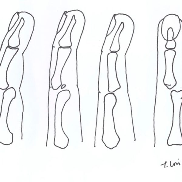 Finger dislocations 600x600